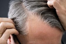 bigstock-Balding-Man-Losing-Hair-Check-396835418-1-300x200