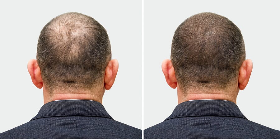 bigstock-The-Head-Of-A-Balding-Man-Befo-443630384