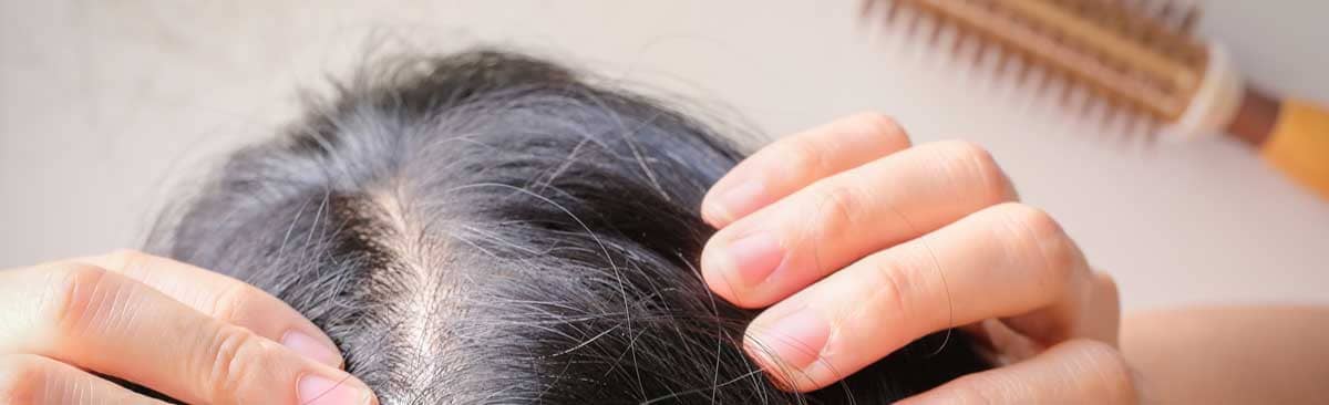 Receding hairline treatment options