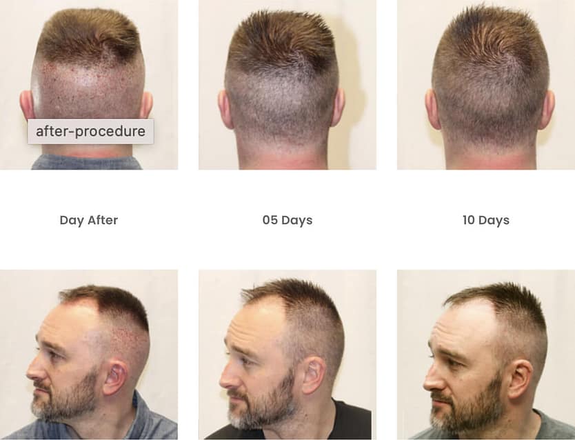 How long does post-op redness last after a hair transplant?