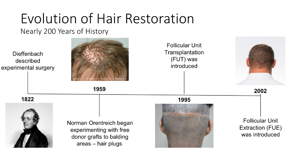 History Of FUE