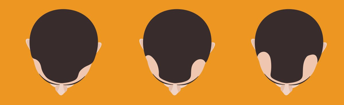Can a hair transplant restore receding temples?