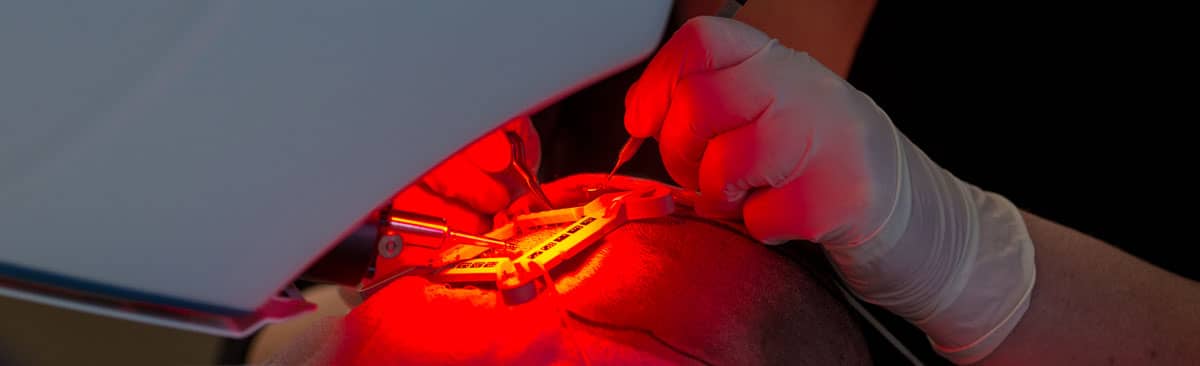 Hair Transplant Recovery: What to Expect