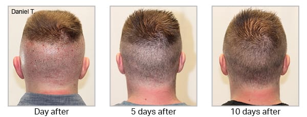 How Soon Can I Return to Work After a Hair Transplant?
