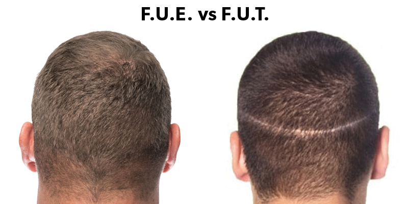 Should I get an FUE or FUT Hair Transplant? The Different Hair Transplant Options