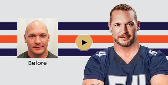 Hair Restoration Results | RESTORE